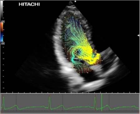VFM using Velocity Vectors and Streamline display in a normal patient